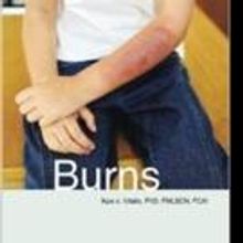 BURNS Helps People With Burn Injuries