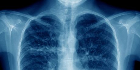 NOVA's THE BATTLE TO BREATHE Documentary to Premiere on PBS Photo